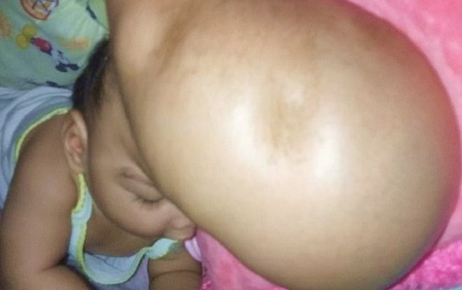 Xót xa lời khẩn cầu của mẹ bé gái có đầu phình to như quả bóng: 'Con gái tôi có thể được cứu mà'