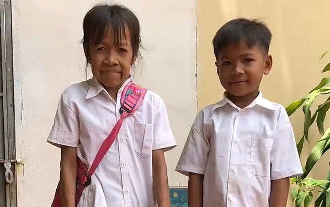 Mắc bệnh lạ, bé gái 10 tuổi có khuôn mặt như cụ bà 60