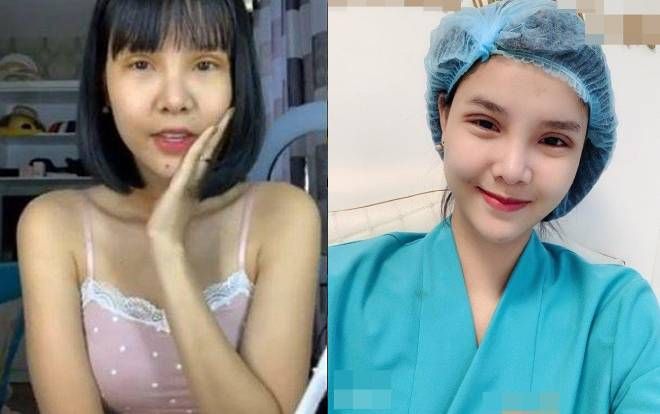 Bị chê xấu xí quê mùa, Kỳ Hân dốc cạn tiền phẫu thuật thẩm mỹ đến mức sưng phù mặt