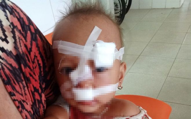 Xảy ra cãi vã với vợ, chồng dùng vật cứng ném trúng mặt con gái 2 tuổi phải khâu 12 mũi