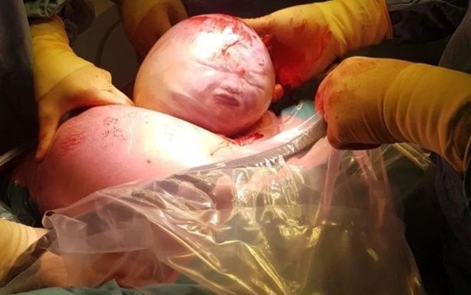 Sản phụ kể lại giây phút con chào đời còn nguyên trong túi ối: 'Đứa bé trông như người ngoài hành tinh'
