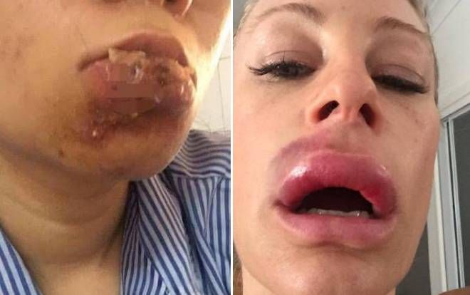 Những đôi môi sưng 'siêu to, khổng lồ' vì tiêm filler giá rẻ, coi xong sợ đến già
