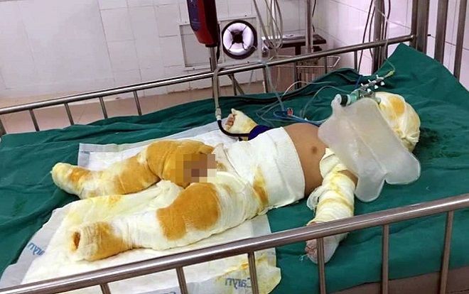 Thương tâm bé trai 7 tháng tuổi cùng cha mẹ bỏng nặng nhập viện cấp cứu do hở bình gas trong lúc đun nấu