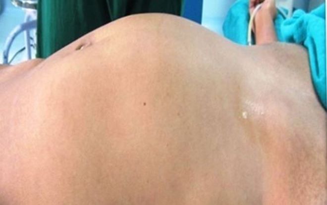 Bụng phình to ngày một đau đớn, cô gái bàng hoàng khi biết lý do