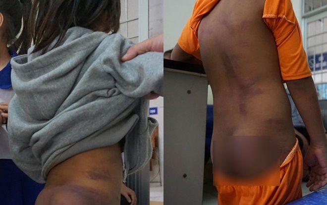 Vụ 4 học sinh tiểu học bị 2 chị họ bạo hành: Có em bị đánh 125 roi và xát muối ớt vào vết thương