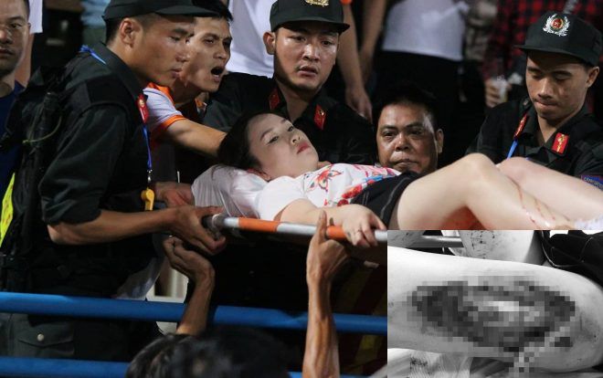 Nữ cổ động viên bị pháo bắn trúng trên sân Hàng Đẫy được xác định bị tổn thương do công phá từ sức nổ với kích thước 15-30cm