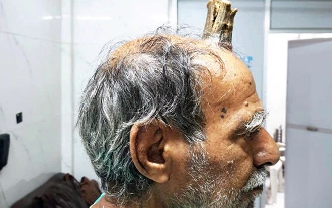 Người đàn ông có 'sừng quỷ' dài 10 cm mọc trên đỉnh đầu
