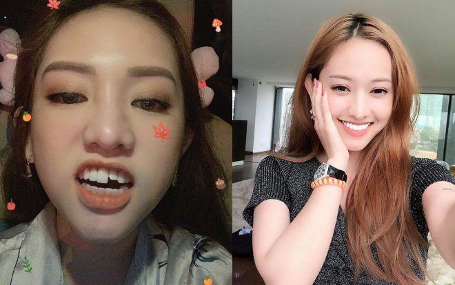 Nhọ như Thuý Vi: Té sấp mặt trong nhà vệ sinh, gãy luôn chiếc răng cửa cả chục triệu