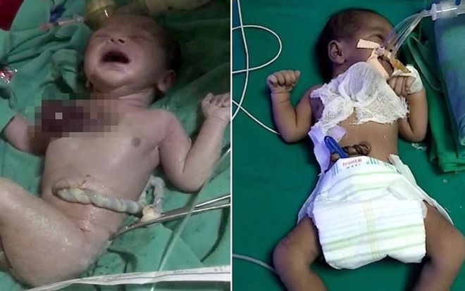 Bé sơ sinh chào đời với trái tim đập ngoài cơ thể