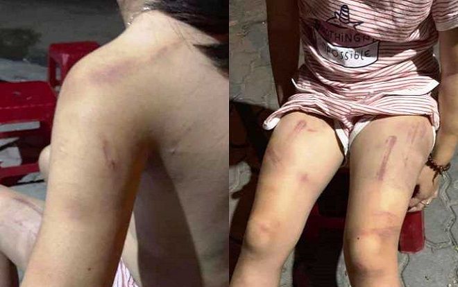 Bé gái 6 tuổi bị cụ nội vung gậy đánh, vết bầm tím chằng chịt khắp cơ thể