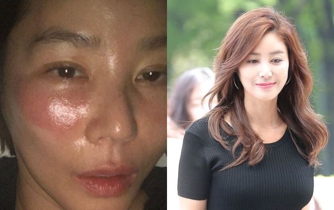 Lỡ đắp mặt nạ qua đêm, Hoa hậu Hàn Quốc bị bỏng rát sưng tấy đỏ cả mặt