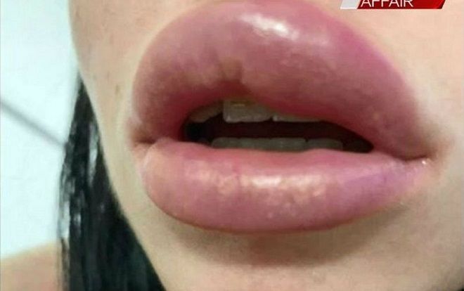 Người phụ nữ suýt bị mù vì đôi môi 'phát nổ'