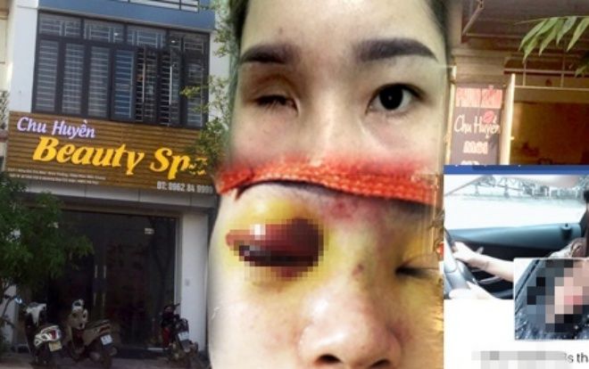 Công an vào cuộc điều tra, làm việc với chủ tiệm spa nâng mũi khiến cô gái bị mù vĩnh viễn