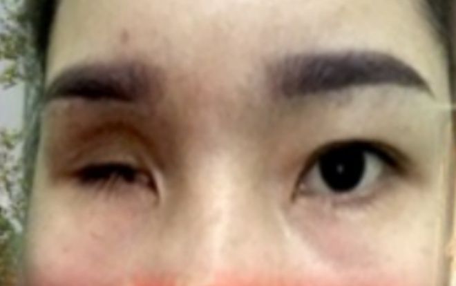 Tiệm spa nâng mũi khiến cô gái bị mù vĩnh viễn từng bị đình chỉ hoạt động