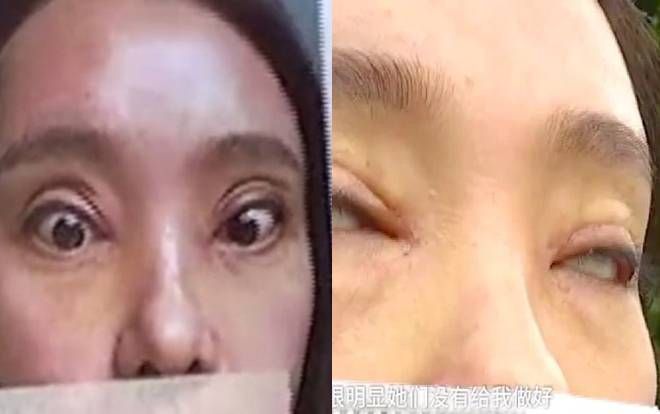 Nghịch cảnh: Tốn tới 40 triệu để cắt mí nhưng cô gái không thể nhắm mắt khi ngủ