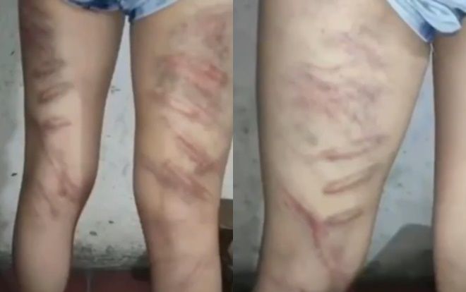 Không học thuộc bài, nữ sinh tiểu học bị cô dùng roi đánh dã man