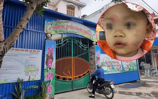 Bé gái 14 tháng tuổi bị nhiều vết bầm tím trên mặt ngay ngày đầu đến lớp