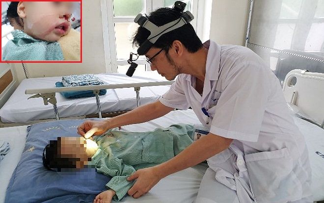 Kinh hoàng bé trai 2 tuổi bị bỏng nặng vì mẹ nhỏ nhầm axit để rửa mũi