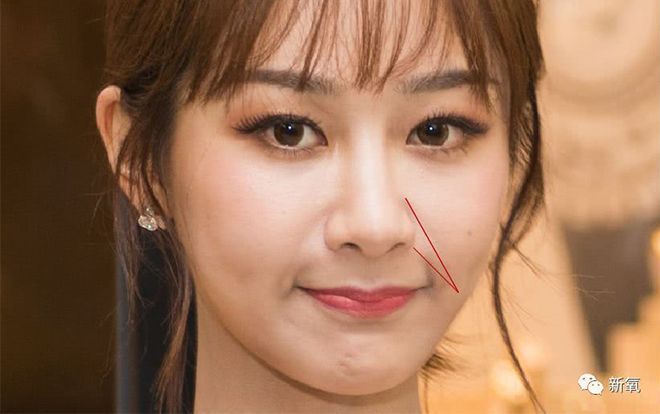 Dân mạng tiếp tục đặt nghi vấn Dương Tử gặp di chứng sau phẫu thuật thẩm mỹ