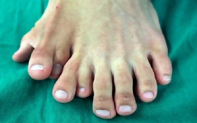 Kỳ lạ chàng trai có đến…14 ngón chân