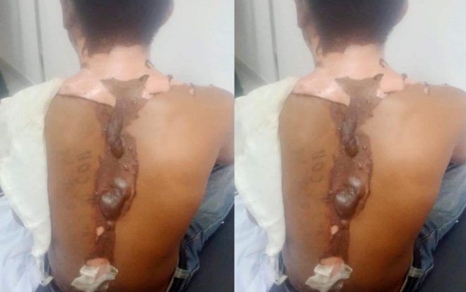 Cha ruột tiết lộ lý do nam thanh niên bị chị gái tạt nước sôi lên người gây bỏng nặng