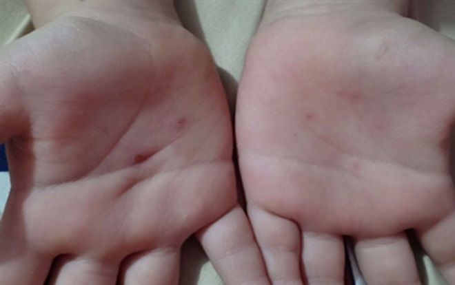 Điều tra thông tin cháu bé 5 tuổi bị giáo viên mầm non dùng vật nhọn đâm vào tay vì không nghe lời