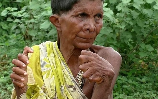 Người phụ nữ có 19 ngón chân, 12 ngón tay bị kỳ thị là 'phù thủy'