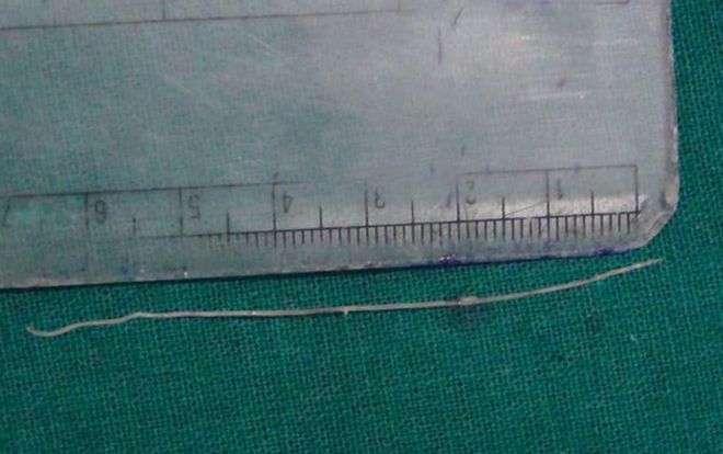 Giun dài 7 cm sống ký sinh trong mắt bệnh nhân suốt 12 năm sau khi bị chó cắn