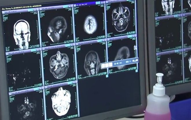 Người đàn ông co giật, mất ý thức vài tuần vì ăn thịt chưa chín