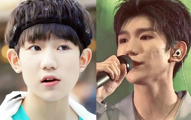 Vương Nguyên gây mất điểm với khuôn mặt đầy mụn, da rỗ sần sùi