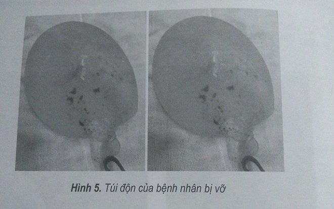 Cô gái 28 tuổi ở Sài Gòn bị vỡ 2 túi độn ngực cùng lúc