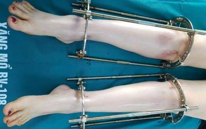 Tin vui cho những người tự ti với chiều cao có hạn khi có thể kéo dài chân thêm 16cm