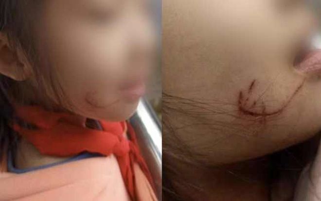 Giáo viên dùng thước đánh vào mặt trẻ nhưng phản ứng của nhà trường mới gây bức xúc
