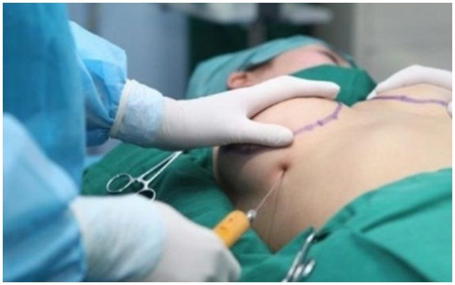 Chi cả núi tiền nâng ngực, 'núi đôi' bỗng biến thành '4 cục u' kỳ lạ