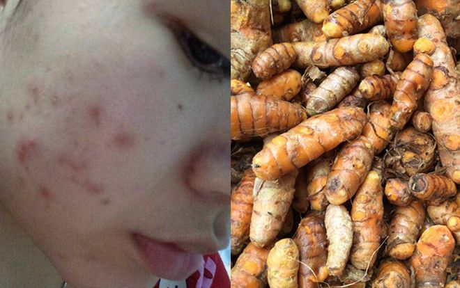 Có ngay 3 cách trị mụn bằng nghệ hiệu quả hơn cả mỹ phẩm tiền triệu