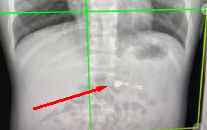 Cậu bé 7 tuổi nhập viện khẩn cấp vì nuối AirPods vào bụng