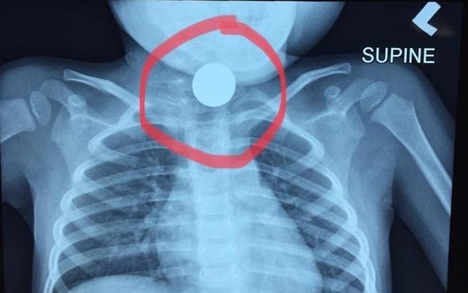 Con nhỏ nuốt phải đồng xu, bà mẹ đưa đi cấp cứu nhưng bệnh viện có phản ứng gây bức xúc