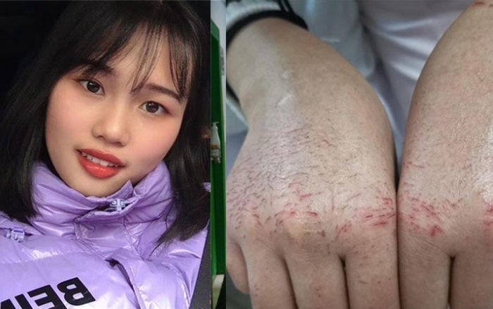 Nữ y tá với đôi tay nứt nẻ tuôn máu vẫn quyết tâm chiến đấu chống virus corona