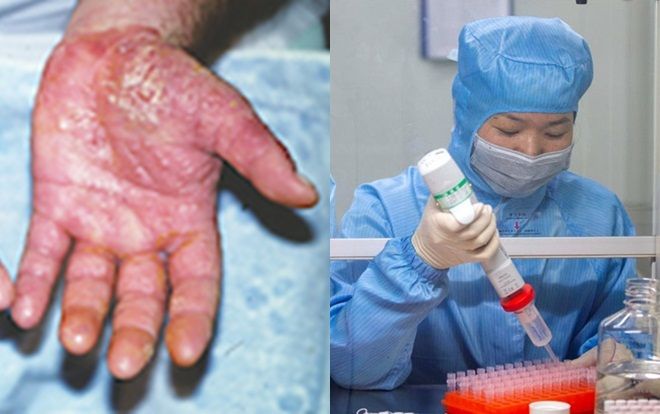 Xót xa đôi bàn tay ửng đỏ, sưng tấy của các bác sĩ Vũ Hán làm việc suốt hơn 12 tiếng mỗi ngày