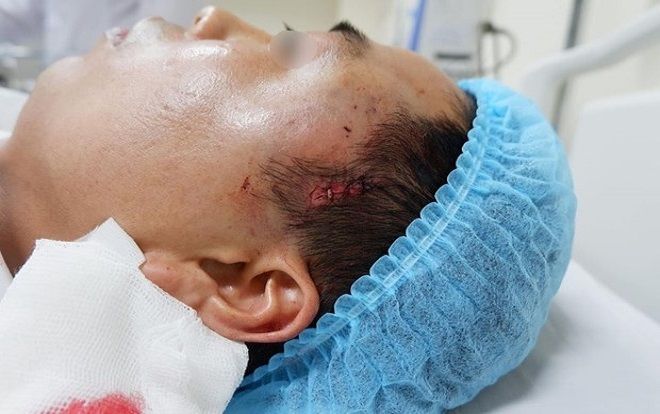 Nam thanh niên chảy máu ồ ạt, suýt chết vì độn thái dương tại thẩm mỹ viện không phép ở Hà Nội