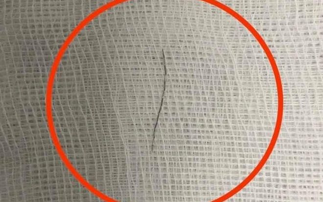 Phẫu thuật lấy đoạn thép dài gần 2cm trong họng bé 13 tháng tuổi