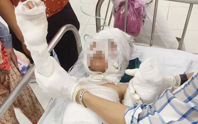 Mâu thuẫn tiền bạc, dì ruột châm xăng đốt cháu gây bỏng nặng