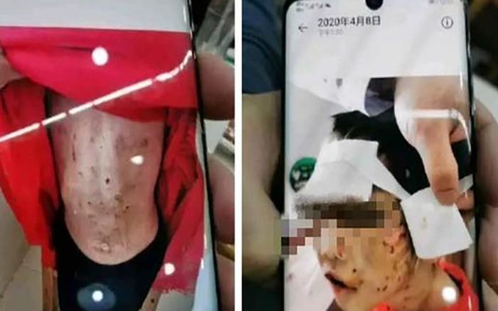 Bé gái 4 tuổi bị bố ruột là HLV taekwondo và mẹ kế đánh đập tàn nhẫn