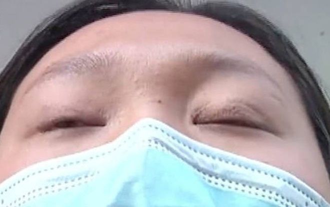 Mắt không thể nhắm sau ca phẫu thuật cắt mí
