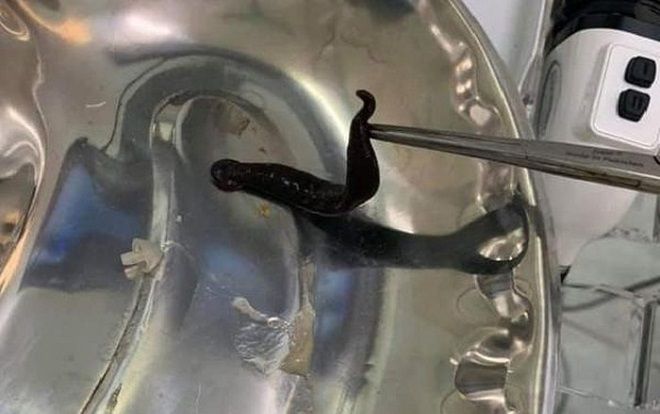Gắp con đỉa dài 10cm 'làm ổ' cả tháng trời trong mũi bé gái