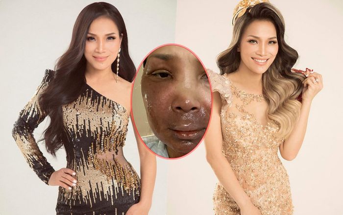 Xúc động với tấm lòng của Hồng Ngọc khi lần đầu đăng tải gương mặt bị bỏng nghiêm trọng