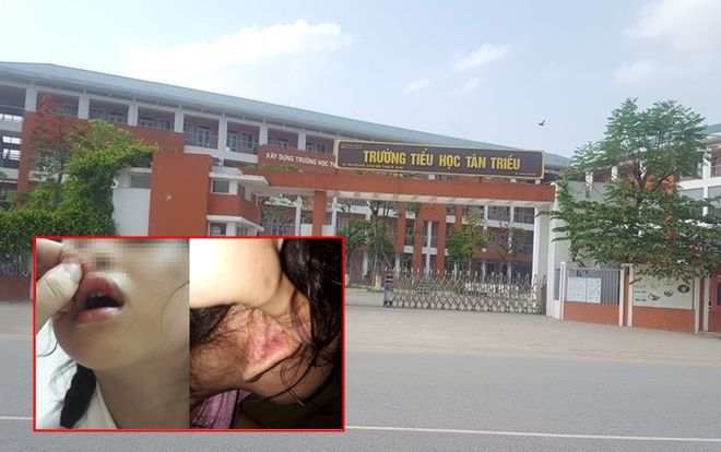 Giáo viên chủ nhiệm lên tiếng phủ nhận việc tát chảy máu, dập môi học sinh lớp 2 vì làm sai bài Toán