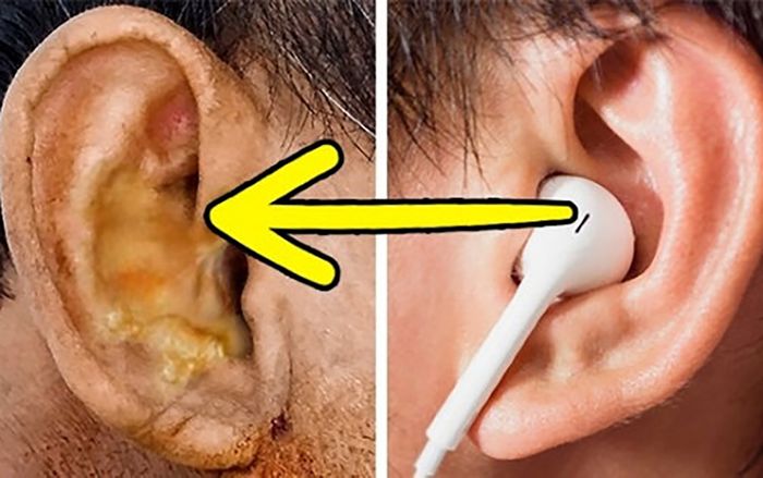 Vì sao bạn không nên cho người khác mượn tai nghe và ngược lại?