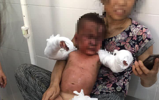 Hai cháu bé ở Nghệ An bị bỏng nặng do nghịch lửa