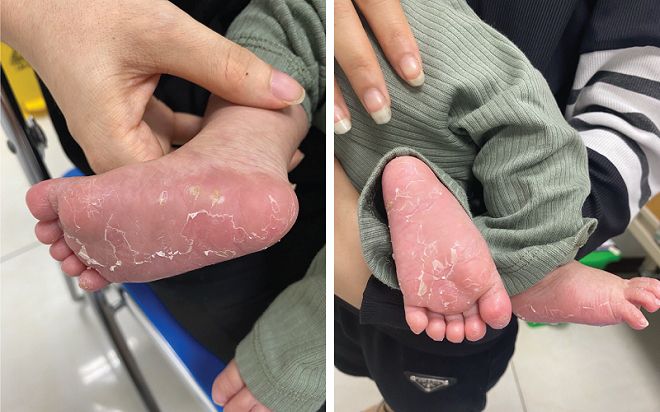 Bé trai 3 tháng tuổi mắc bệnh giang mai vì 1 nguyên nhân không ngờ